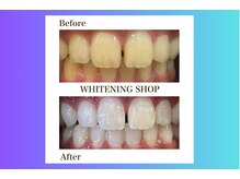 ホワイトニングショップ北四番丁店【4月中旬 NEW OPEN（予定）】/【ビフォーアフター】