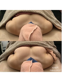 ココシア 取手店(COCOCIA)/バストアップ症例★