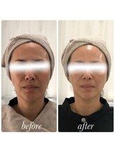 ベルフィーヌボーテ(BELFINE beaute)/サーマル×エクソソーム