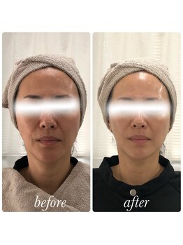 ベルフィーヌボーテ(BELFINE beaute)/サーマル×エクソソーム