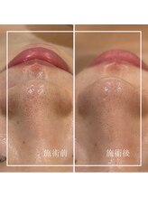 リリーガーデン 手稲店(Lily Garden)/ビフォーアフター【毛穴】