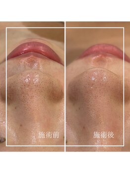 リリーガーデン 手稲店(Lily Garden)/ビフォーアフター【毛穴】