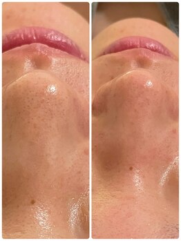 ルカシエ(Le Cacie)/20代女性/小鼻黒ずみ改善