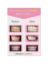エクシアホワイトニング 草津店/ホワイトニングビフォーアフター