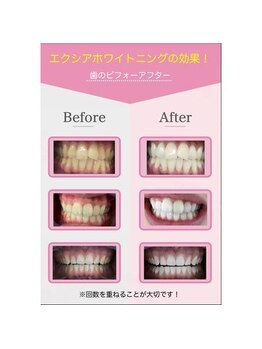 エクシアホワイトニング 草津店/ホワイトニングビフォーアフター