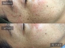 アムールサロン(Amour salon)/光フェイシャルでシミケア/新宿