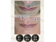 レジェンド 鹿児島店の雰囲気（ヒゲがどんどん抜ける！！青髭も目立ちにくくなるので清潔感UP）