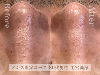 ディレイア ザ コスメ 有楽町マルイ店(direia the cosme)/メンズ/皮脂/角栓［有楽町］