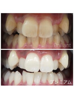 ブリリアント 各務原/他店にない本格ホワイトニング!