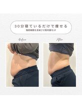 リメレ(Rimere)/スカルプト5回での変化！