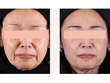 ラグラン銀座メディカルエステ 高輪ゲートウェイ店/【FACE】セルマジ・ビフォアフ