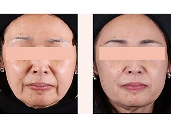 ラグラン銀座メディカルエステ 高輪ゲートウェイ店/【FACE】セルマジ・ビフォアフ
