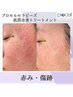 【ご新規様】50,000円→41,000円【赤み・傷跡】肌質改善トリートメント