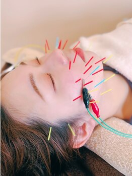 ミー(Mi)の写真/≪美容鍼専門スタッフ在籍≫たるんだフェイスラインをケアする小顔/リフトアップ美容鍼＆高周波