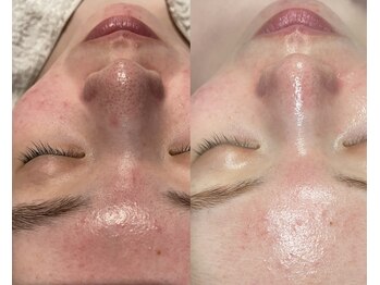 インチャント(enchant)/赤みとプツプツがお悩み