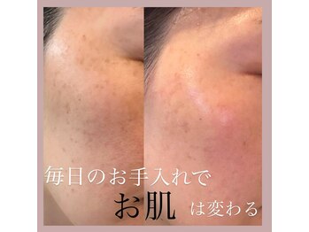 ルテラ(Lutella)/肌改善で手に入れるツヤ肌