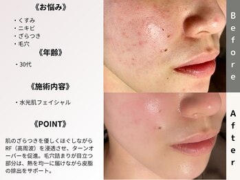 ルディラ 上野店/水光肌フェイシャル