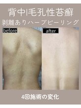 エト(eto.)/背中毛孔性苔癬