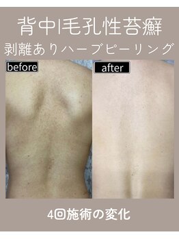 エト(eto.)/背中毛孔性苔癬