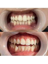 セルフ脱毛サロン　SELFMADE イオンタウン仙台泉大沢店【3/29 NEW OPEN（予定）】 /ホワイトニングビフォーアフター