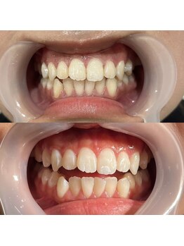 セルフ脱毛サロン SELFMADE イオンタウン仙台泉大沢店【3/29 NEW OPEN(予定)】 /ホワイトニングビフォーアフター