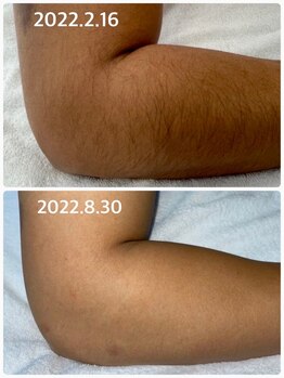 バロン/部分脱毛効果2