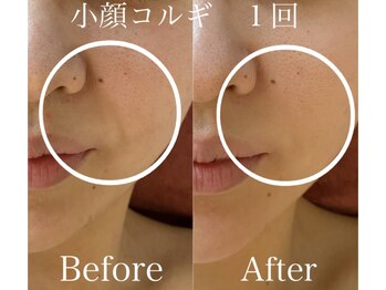 エイミー(Amy)/ほうれい線解消