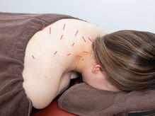 けいのき鍼灸整骨院/施術風景*鍼/肩こり/整体/リンパ