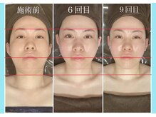 千歳の女神 西尾本店/【施術風景】Before/After