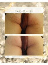 スノースキン(Snow skin)/ニキビケア/ハーブピーリング