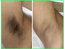 クリア 尾張旭店(Clear)/【Clear脱毛ビフォーアフター】