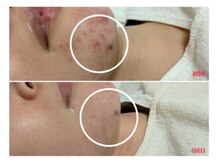 サロンドットブレスドットケイ(salon.bless.k)の雰囲気（return10/たるみ/大人ニキビ/毛穴/ハリ/二重アゴ/若見え肌）