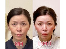小顔22 ボルティ 本店(Bolty)/50代女性/中顔面矯正/14回目