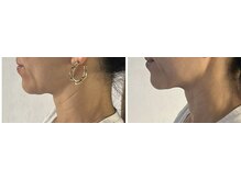 エム ビューティー(M Beauty)/セルラム　ビフォア＆アフター