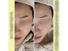 ハニエル(Haniel)/カーボキシー症例