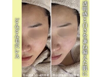 ハニエル(Haniel)/カーボキシー症例