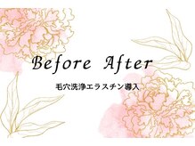 キレイ(KIREI)/毛穴洗浄エラスチン導入