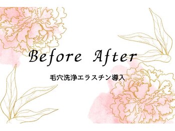 キレイ(KIREI)/毛穴洗浄エラスチン導入