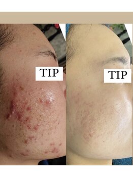 ノヴェイル(NoVeil)/Before/After