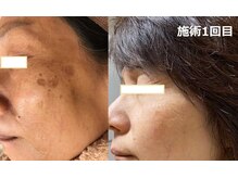 ナチュレアンドメディカ(Nature&Medica)/YAG laser（シミ特化改善）