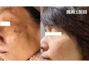 ナチュレアンドメディカ(Nature&Medica)/YAG laser(シミ特化改善)