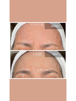 シャンディ(Shandy)/眉間のしわ&くすみ改善☆