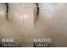 リル バイ アンドアール(Rire by and.R)/シミケア（施術2回）