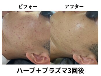 オウカ(OUKA)/ハーブとプラズマで早く効く