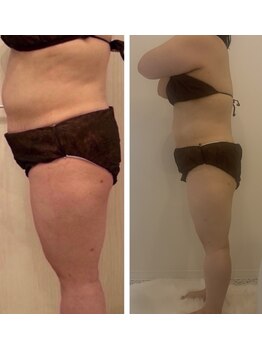 メゾン アンジュ(Maison Ange)/【痩身】高周波超音波