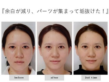 エピファニー(Epiphany)/30代　動画で顔の歪みに気づき…