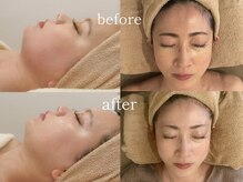 【小顔・たるみ改善・ハリツヤ】インディバ左はレモンボトル追加