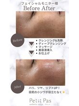プティパ(Petit Pas)/フェイシャルビフォーアフター