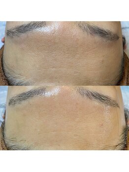 アロー(Allo!)/ハーブピーリングでお肌変化