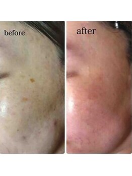 ブランシェ 金沢店 × 椿/シミケア　お客様